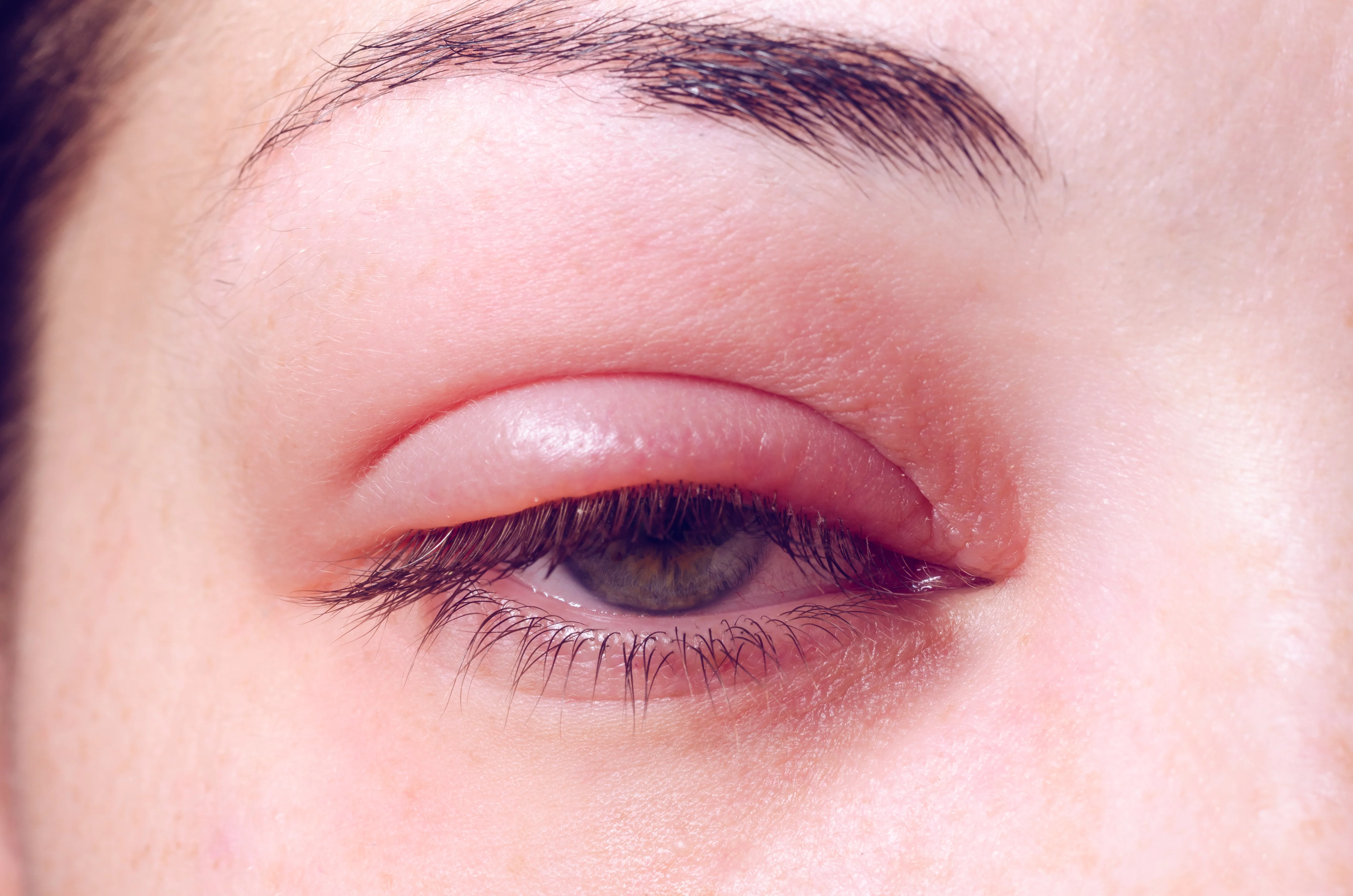 Infection oculaire