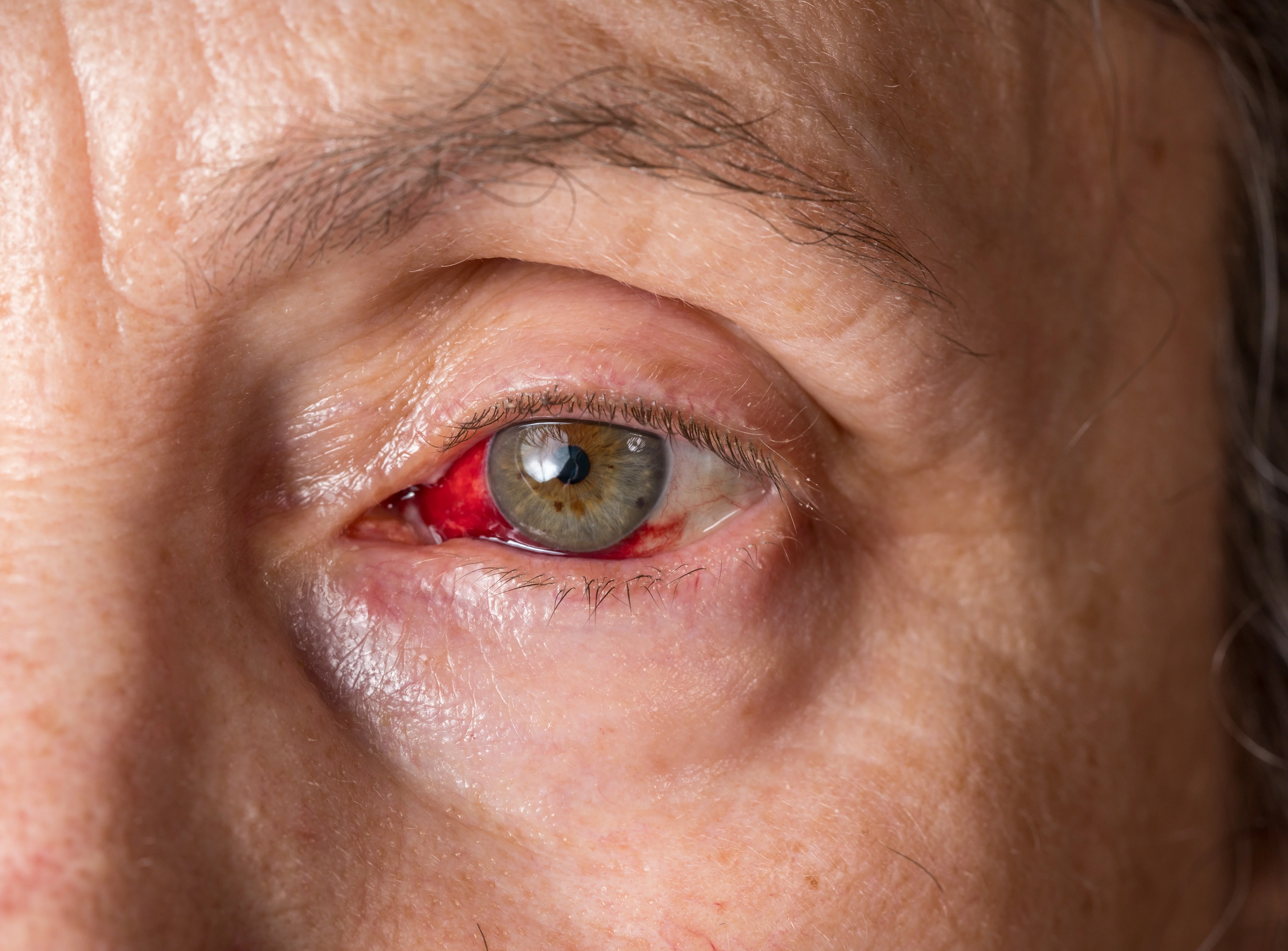 Inflammation oculaire
