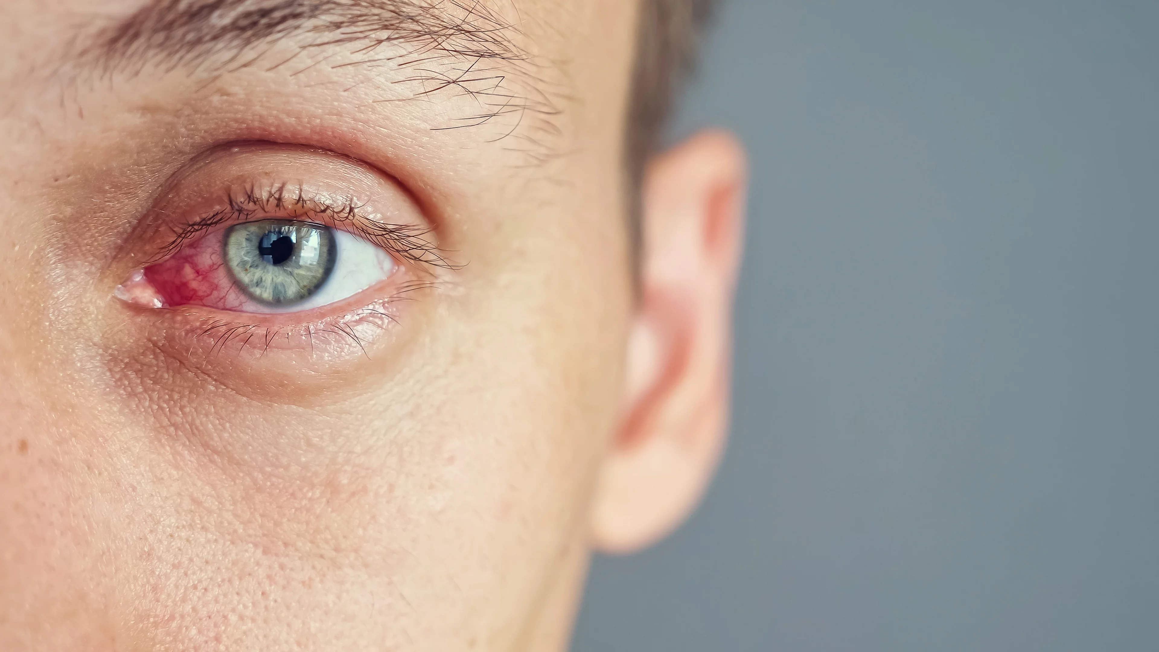 Sécheresse oculaire